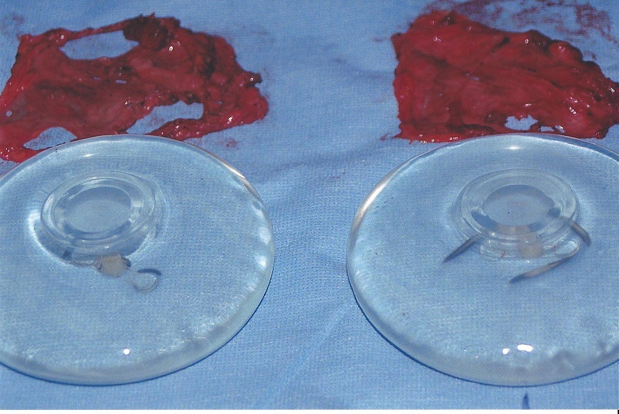 implants and capsules