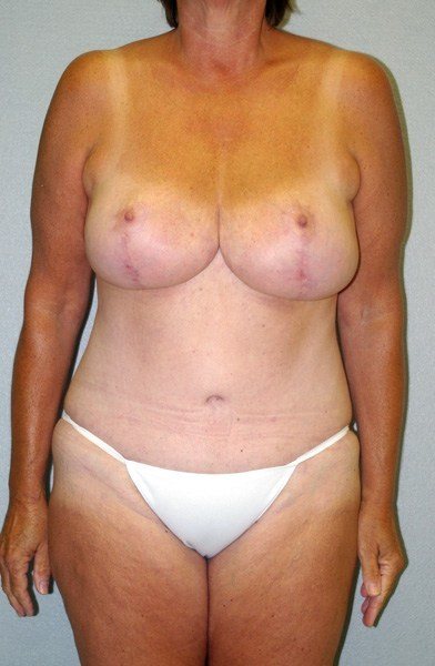Breast Reduction - Dr. Peter Marzek