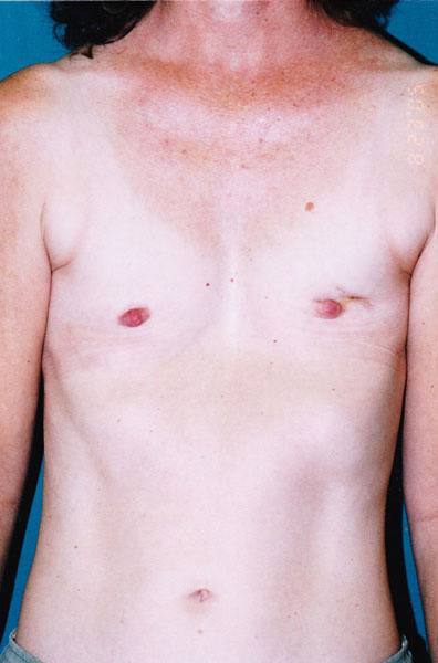 Breast Reconstruction - Dr. Peter Marzek