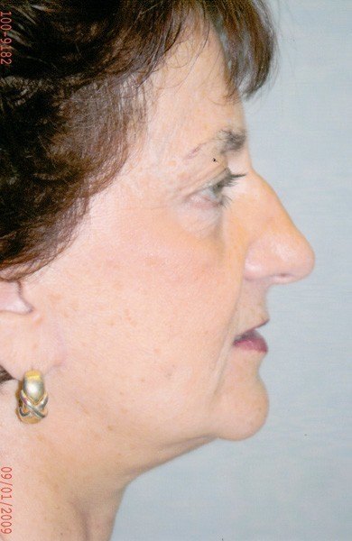 Combined Facial Procedures - Dr. Peter Marzek