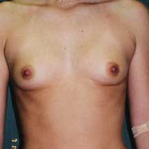 Breast Augmentation - Dr. Peter Marzek