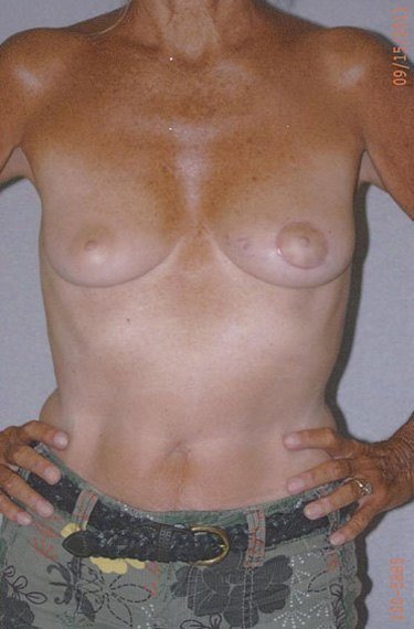Combined Breast Procedures - Dr. Richard Bosshardt
