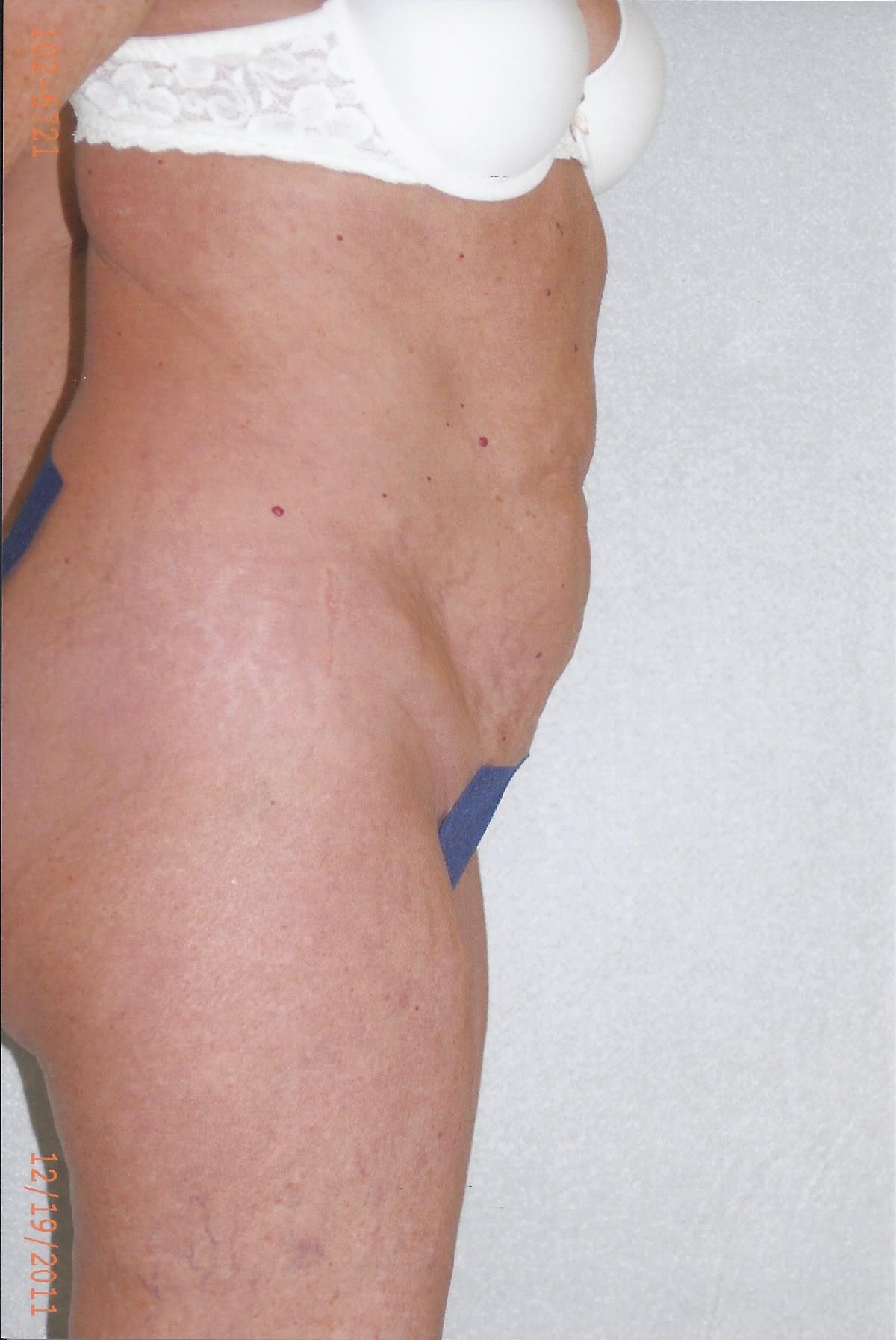 Abdominoplasty - Dr. Richard Bosshardt
