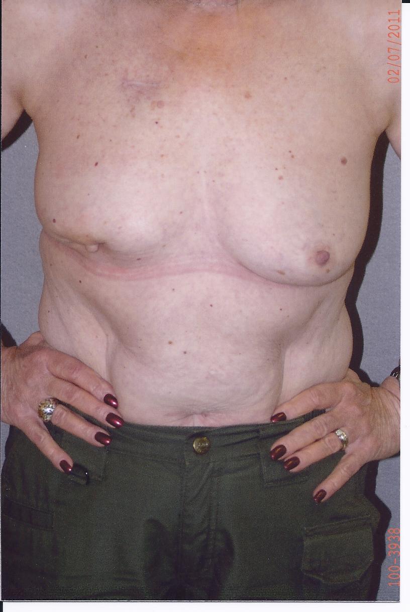 Breast Reconstruction - Dr. Richard Bosshardt