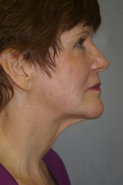 Combined Facial Procedures - Dr. Peter Marzek