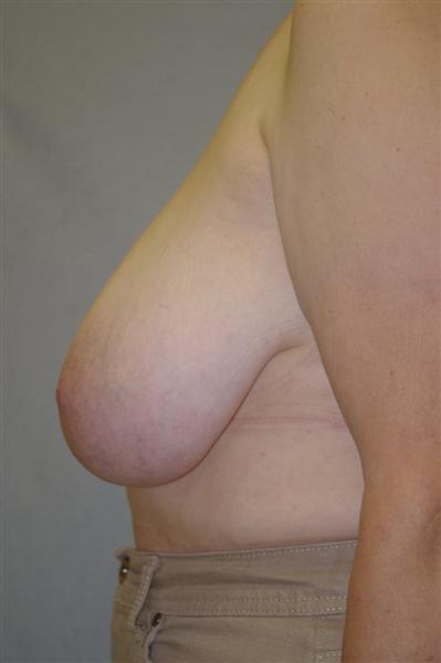 Breast Reduction - Dr. Peter Marzek