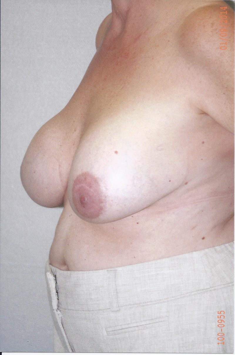 Breast Lift - Dr. Richard Bosshardt