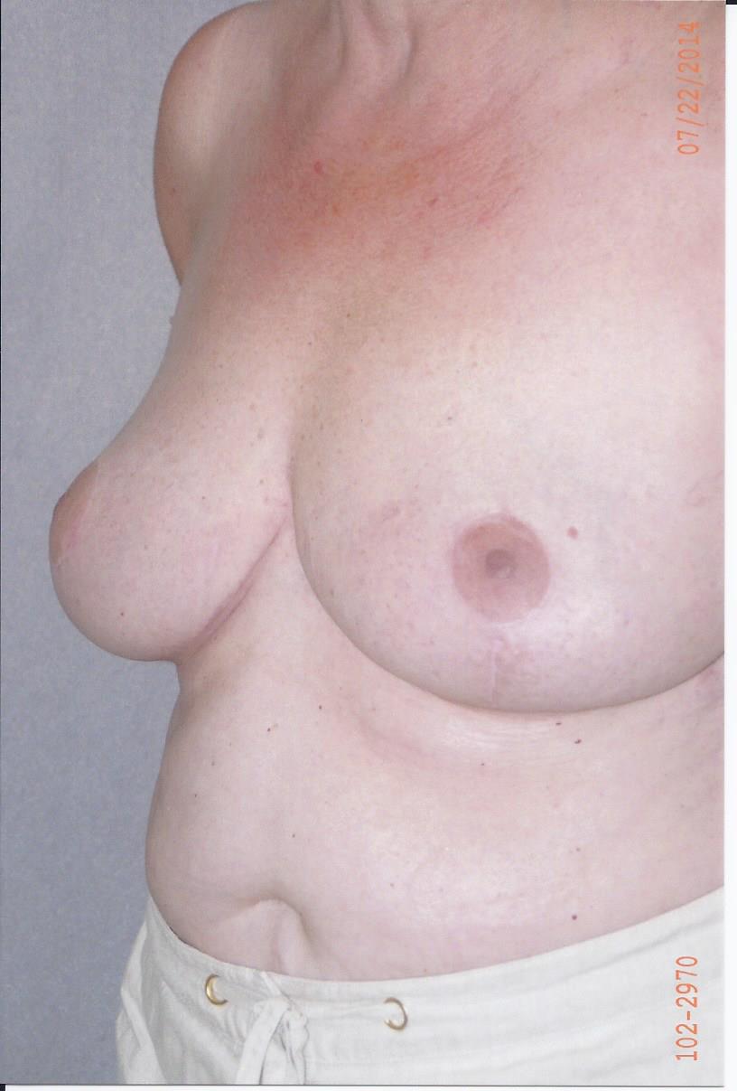 Breast Lift - Dr. Richard Bosshardt