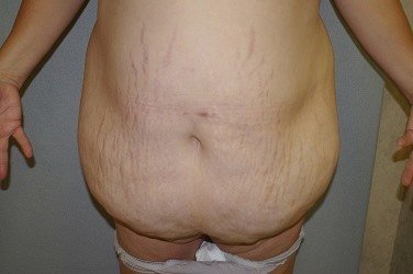 Panniculectomy - Dr. Peter Marzek