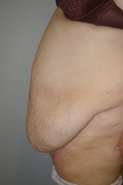 Panniculectomy - Dr. Peter Marzek