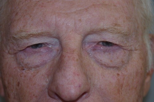 Eyelid Rejuvenation - Dr. Richard Bosshardt