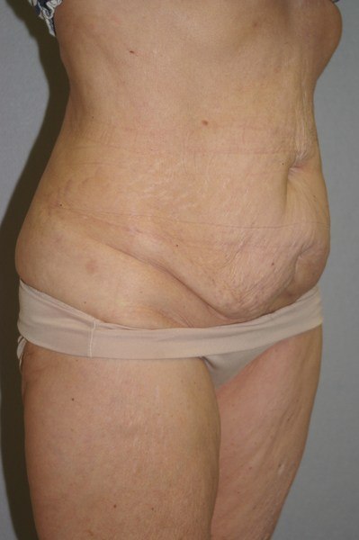 Abdominoplasty - Dr. Peter Marzek
