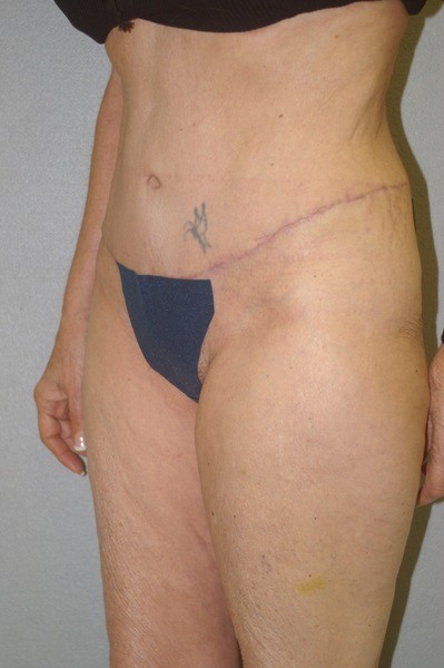 Abdominoplasty - Dr. Peter Marzek