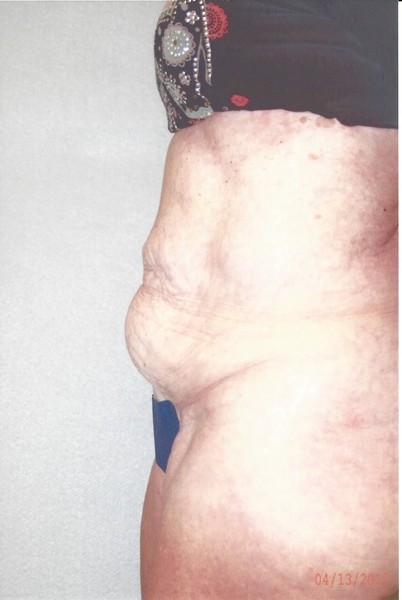 Abdominoplasty - Dr. Richard Bosshardt