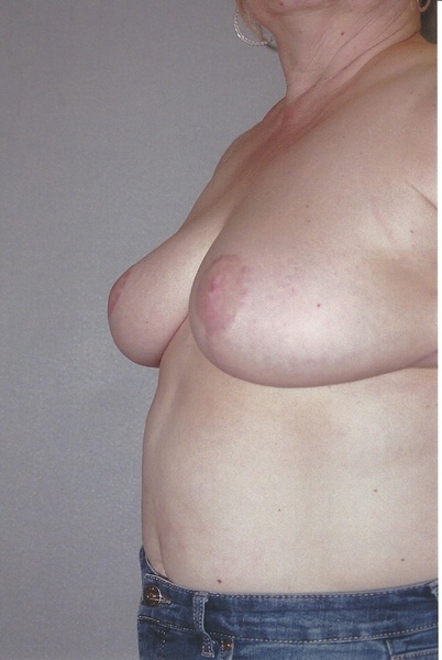 Breast Reduction - Dr. Richard Bosshardt