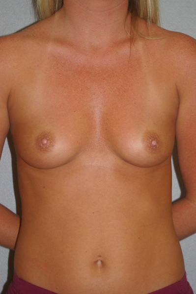 Breast Augmentation - Dr. Peter Marzek