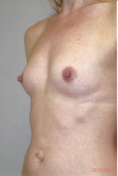 Breast Augmentation - Dr. Richard Bosshardt
