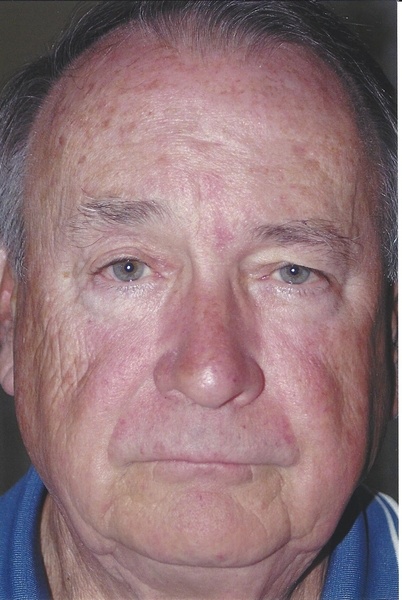 Forehead/Brow Lift - Dr. Richard Bosshardt