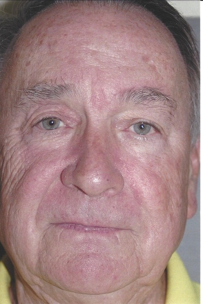 Forehead/Brow Lift - Dr. Richard Bosshardt