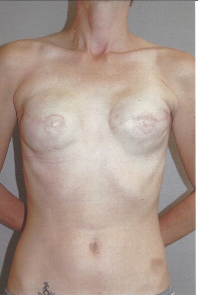 Breast Reconstruction - Dr. Richard Bosshardt