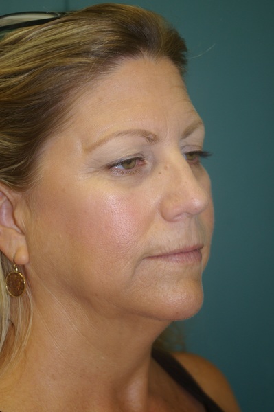 Forehead/Brow Lift - Dr. Peter Marzek