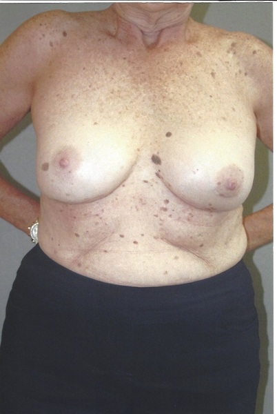 Breast Augmentation - Dr. Richard Bosshardt