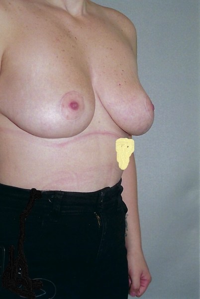Breast Reduction - Dr. Richard Bosshardt