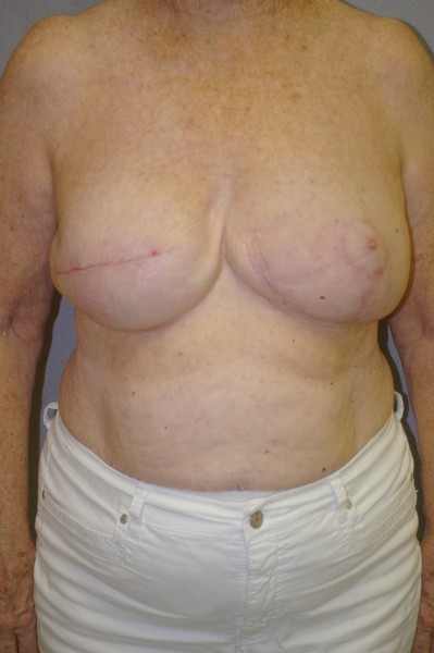 Breast Reconstruction - Dr. Peter Marzek