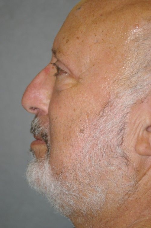 Eyelid Rejuvenation - Dr. Peter Marzek