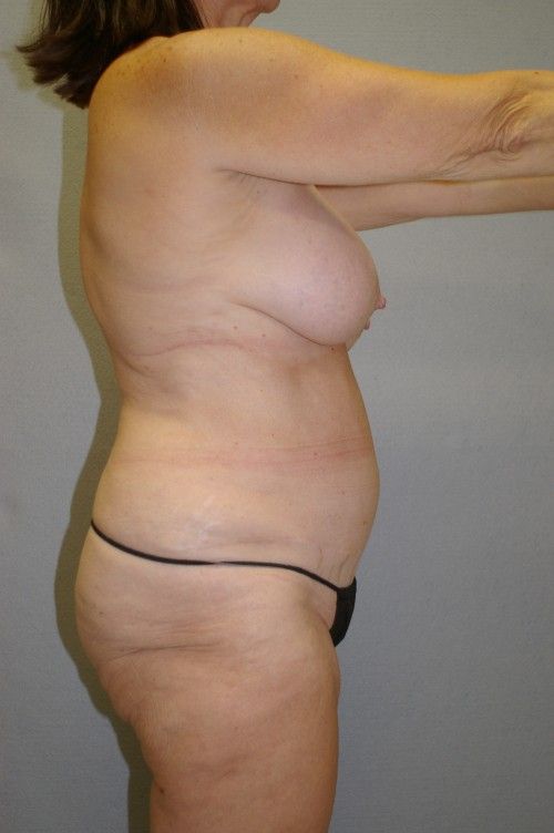 Liposuction/LifeSculpt - Dr. Peter Marzek