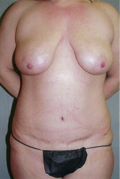 Combined Breast Procedures - Dr. Richard Bosshardt